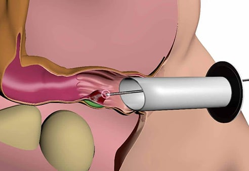 Wie wir die Rafaelo-Therapie bei Hämorrhoiden anwenden